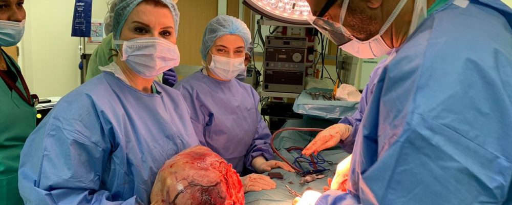 University Hospital Of Sharjah Doctors Remove Six-kg Uterine Fibroid From 28-Yr-Old Patient During Complex, High-Risk Surgery